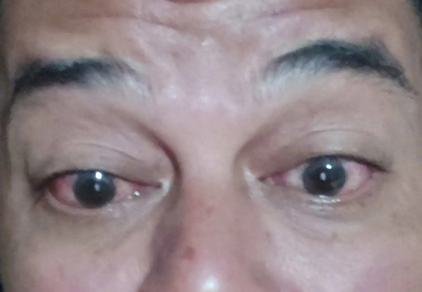 Penyakit Mata Menular, Banyak Warga Terpapar. Kepala Puskesmas Nanggung Himbau Warga Jaga Kebersihan 